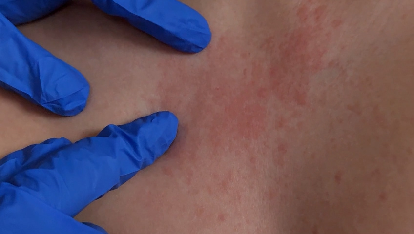 Alerta de Sarampión en Mexicali: Brote Identificado y Pacientes Contagiados